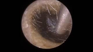 799 - Armageddon Ear Wax Removal