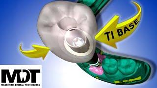 TI Base Implant Crown Design With Exocad [ Model Creator Bonus Implant Ti-Base Design Tutorial ]