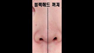 코 피지 제발 짜지 마세요. 블랙헤드 제거하는 진짜 방법 Do this to get rid of black heads #shorts