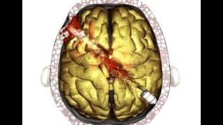 Brain Injury - Gunshot