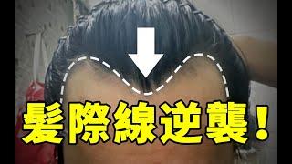 【髮際線後移】導致髮際線後移的原因有哪些？髮際線後移如何改善？丨植髮醫生徐魯