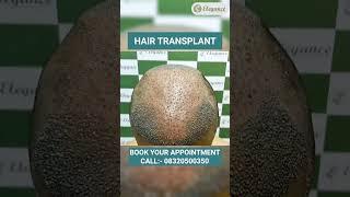 Hair transplant Treatment, Hair Baldness, Hair Growth Treatment in Vesu, Piplod, Surat