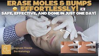  Bump-Free Skin in a Day: CO2 Laser Mole Removal! 