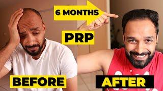  PRP 6 MONTH RESULTS - 3 PRP sessions | HAIR TRANSPLANT vs PRP which one should you really go for?