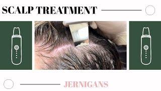 Scalp Treatment to Remove MASSIVE Buildup