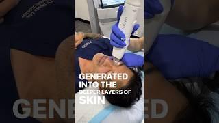 RF Micro-needling to regenerate Collagen