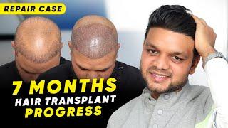 Hair Transplant in Chennai | Best Results & Cost of Hair Transplant in Chennai