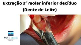 Extração 2º molar decíduo (Dente de Leite)