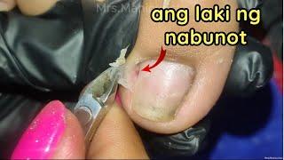 Vlog 1122|Dry Skin/Ingrown Removal| PEDICURE 1022