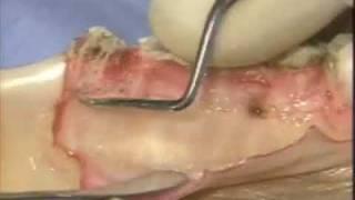 Introductory Periodontal Surgical Techniques: The Apically Positioned Flap and Crown Lengthening