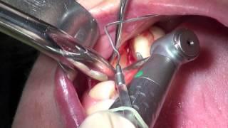 Implant Surgery Bridge - Explicit - Live surgery