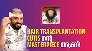 HAIR TRANSPLANTATION CUTIS ന്റെ MASTERPIECE ആണ്!