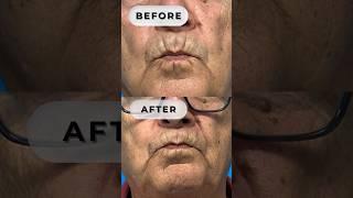 The best way to get rid of #SmokersLines #beforeandafter #smokerslinestreatment