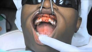 Zeramex Ceramic Implant Surgery by Philip Gordon DDS Dental Implant Practices