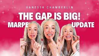 The gap is so big! | Marpe Update