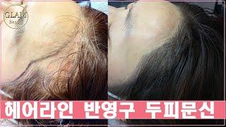 대구 SMP 반영구 헤어라인 두피문신 대구글램뷰티본점