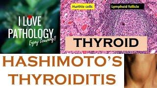 HASHIMOTO'S THYROIDITIS: Etiopathogenesis, Morphology & Complications