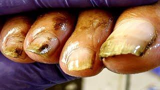The entire foot is trimmed! clean dirt【Pedicure King】
