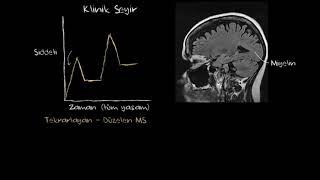 Multipl Sklerozun Klinik Seyri (Fen Bilimleri) (Sağlık ve Tıp)