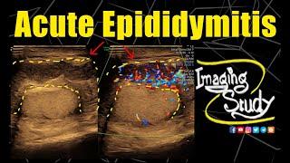 Acute Epididymitits || Ultrasound || Case 339