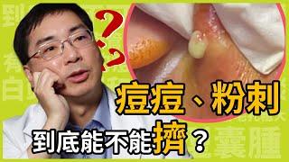 粉刺、痘痘到底能不能擠？如果不能擠應該怎麼處理才不會留疤？皮膚科林政賢醫師教你這樣擠痘才正確！