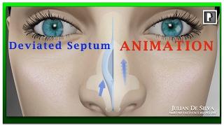 Rhinoplasty Animation - How can Breathing be improved by correcting a Deviated Septum?