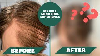 I Have Been Using Minoxidil For 1 Year And Here Are The Results - My Full Minoxidil Experience