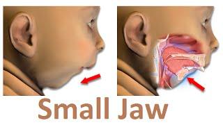What is the Main Reason of Small Jaw (Micrognathia) by Prof John Mew