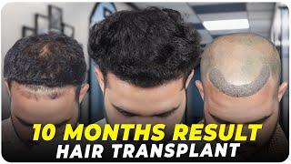 Hair Transplant in Tirupati | Best Results & Cost of Hair Transplant in Tirupati