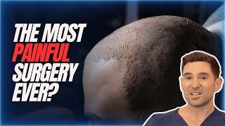 How Painful is a Hair Transplant? Is it the Most Painful Procedure? 