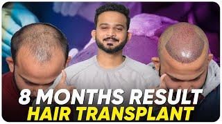 Hair Transplant in India | Best Results & Cost of Hair Transplant in India