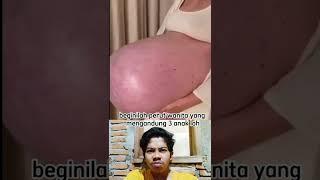 begini perut gantung ibu hamil yang mengerikan #shorts #reaction #ibuhamil #dokter