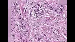 Histopathology Bladder --Urothelial carcinoma Grade III