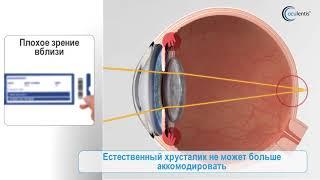 LENTIS Mplus. Мультифокальные линзы для коррекции возрастной дальнозоркости