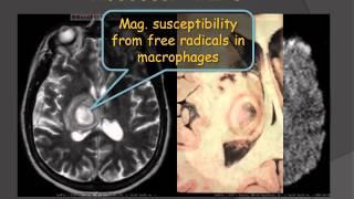 Brain Imaging - Ring Enhancing Lesions