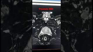 MRI prostate