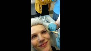 JETT PLASMA LIFT MEDICAL - Dr. Jestřábová performs treatment of Blepharoplasty