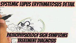 Systemic Lupus Erythmatosus