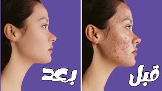 ازاله الحبوب وتنقيه الوجه وعمل ريتاتش للبشره من الهاتف | skin retouching