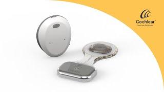 How the Cochlear™ Osia® System works