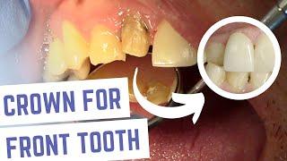 Dental Crown [Front Tooth] Steps Explained