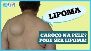 Caroços na pele? Pode ser lipoma!