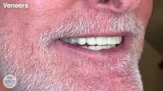 Veneers