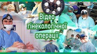 Коагуляція маткових артерій при великих розмірах міоми з послідуючою міомектомією