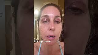 Eyelid surgery recovery - blepharoplasty - 6 days after upper lid surgery