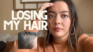 Hair Loss | PCOS, Tips & Faith