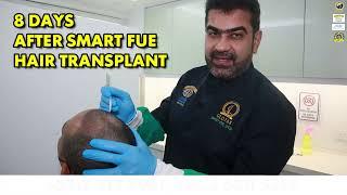 Hair Transplant in Kuala Lumpur | 8 Days After 2500 Grafts SMART FUE Hair Transplant | GLOJAS