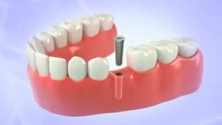 Dental Implant Fort Lauderdale FL | Dr. Sawan Malik