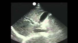 How To: Gallbladder Ultrasound Part 1 - Introduction Case Study Video