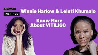 Celebrating Winnie Harlow & Leleti Khumalo | World Vitiligo Day | Totally Inspired with Sibo Dube